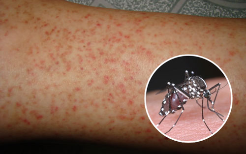 Bệnh dịch sốt xuất huyết do thủ phạm muỗi vằn gây ra